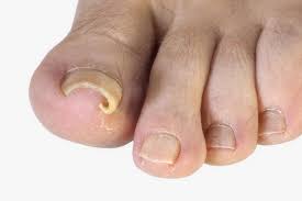Twisted nail case study 1